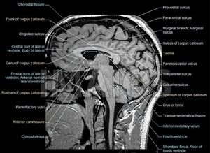 mri of the brain