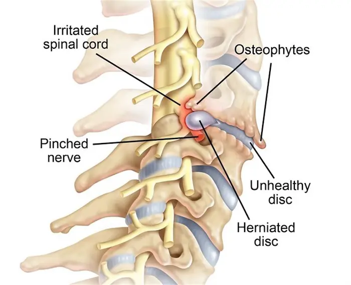 Pinched Nerves from auto accident