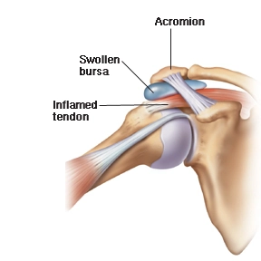 Shoulder injuries